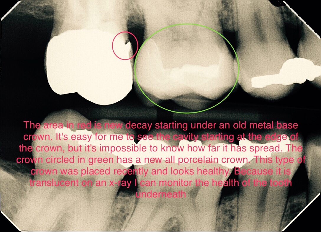 Dental Crowns